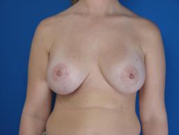 mastopexy-and-breast-augmentation-macon mastopexy-and-breast-augmentation-macon