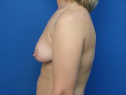 mastopexy-and-breast-augmentation-macon