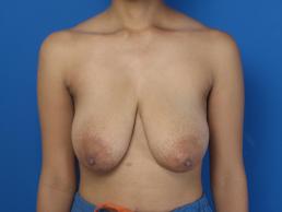 mastopexy-macon mastopexy-macon