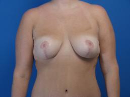 mastopexy-macon mastopexy-macon
