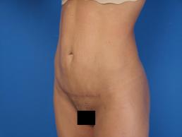 modified-abdominoplasty-macon modified-abdominoplasty-macon