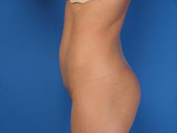 modified-abdominoplasty-macon modified-abdominoplasty-macon
