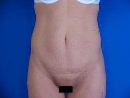 modified-abdominoplasty-macon modified-abdominoplasty-macon