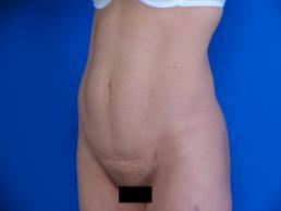 modified-abdominoplasty-macon modified-abdominoplasty-macon