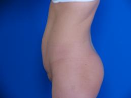 modified-abdominoplasty-macon modified-abdominoplasty-macon
