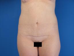modified-abdominoplasty-macon modified-abdominoplasty-macon