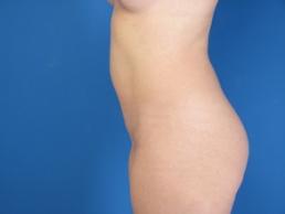 modified-abdominoplasty-macon modified-abdominoplasty-macon
