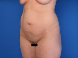 modified-abdominoplasty-macon modified-abdominoplasty-macon