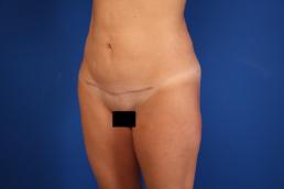modified-abdominoplasty-macon modified-abdominoplasty-macon