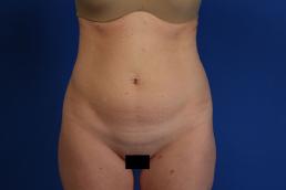 modified-abdominoplasty-macon modified-abdominoplasty-macon