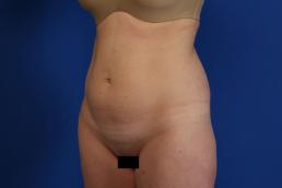 modified-abdominoplasty-macon modified-abdominoplasty-macon