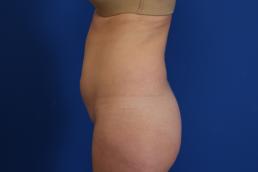 modified-abdominoplasty-macon modified-abdominoplasty-macon