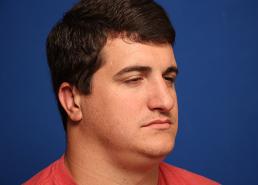 rhinoplasty-macon rhinoplasty-macon