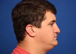 rhinoplasty-macon rhinoplasty-macon