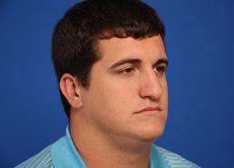 rhinoplasty-macon rhinoplasty-macon