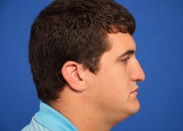 rhinoplasty-macon rhinoplasty-macon