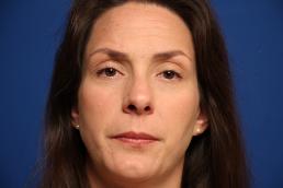 rhinoplasty-macon rhinoplasty-macon