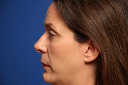 rhinoplasty-macon rhinoplasty-macon
