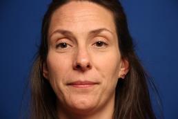 rhinoplasty-macon rhinoplasty-macon