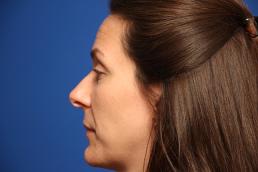 rhinoplasty-macon rhinoplasty-macon