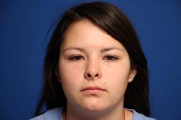 rhinoplasty-macon rhinoplasty-macon