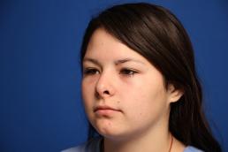 rhinoplasty-macon rhinoplasty-macon
