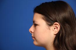 rhinoplasty-macon rhinoplasty-macon