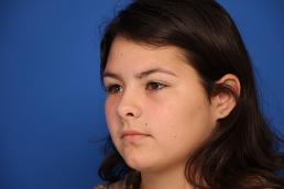 rhinoplasty-macon rhinoplasty-macon