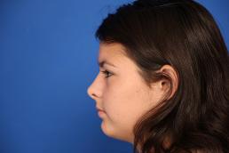 rhinoplasty-macon rhinoplasty-macon
