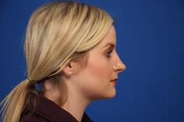 rhinoplasty-macon rhinoplasty-macon