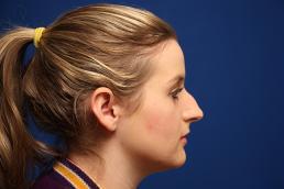 rhinoplasty-macon rhinoplasty-macon