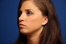 rhinoplasty-macon rhinoplasty-macon