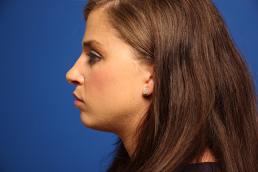 rhinoplasty-macon rhinoplasty-macon