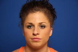 rhinoplasty-macon rhinoplasty-macon