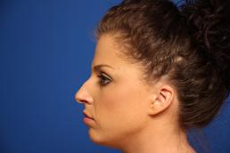 rhinoplasty-macon rhinoplasty-macon