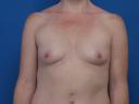 breast-augmentation-macon