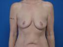 breast-reconstruction-free-tram-macon
