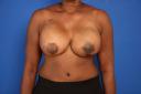 breast-reconstruction-free-tram-macon